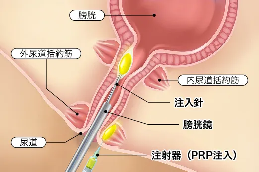尿道周囲へのPRP注射の図解