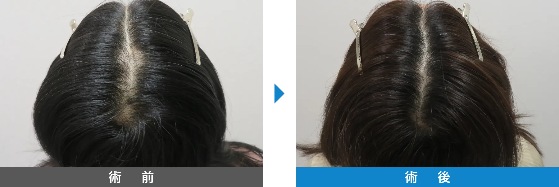 w-スカルプ 症例写真 術後