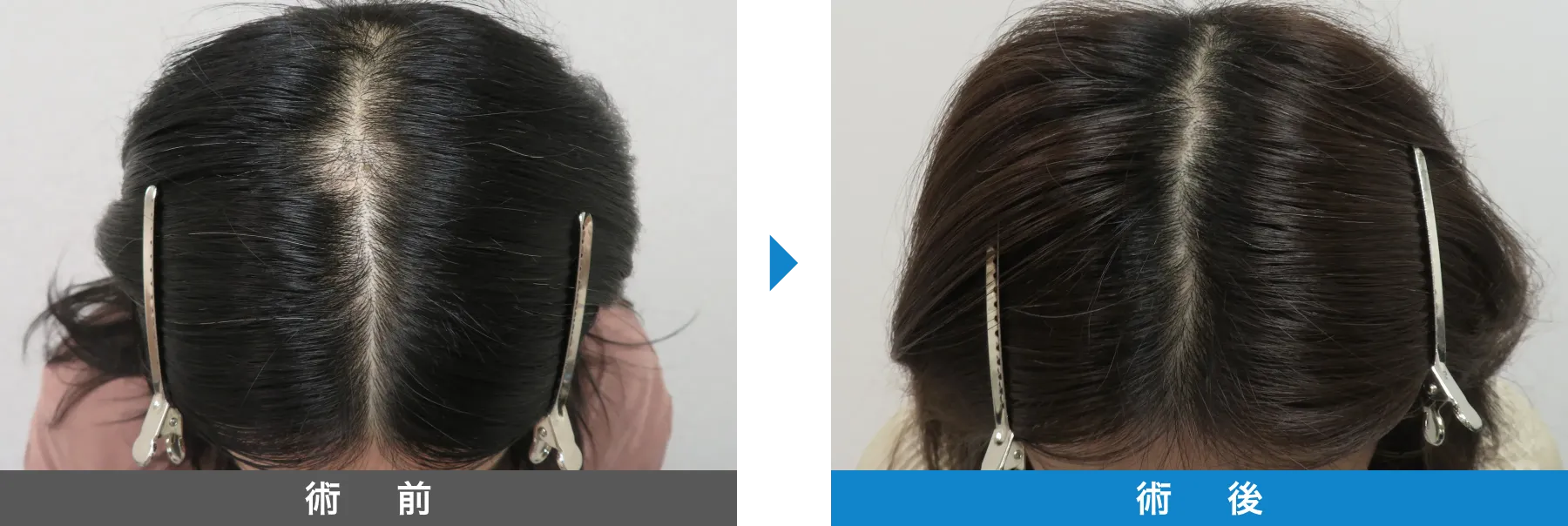 w-スカルプ 症例写真 術後