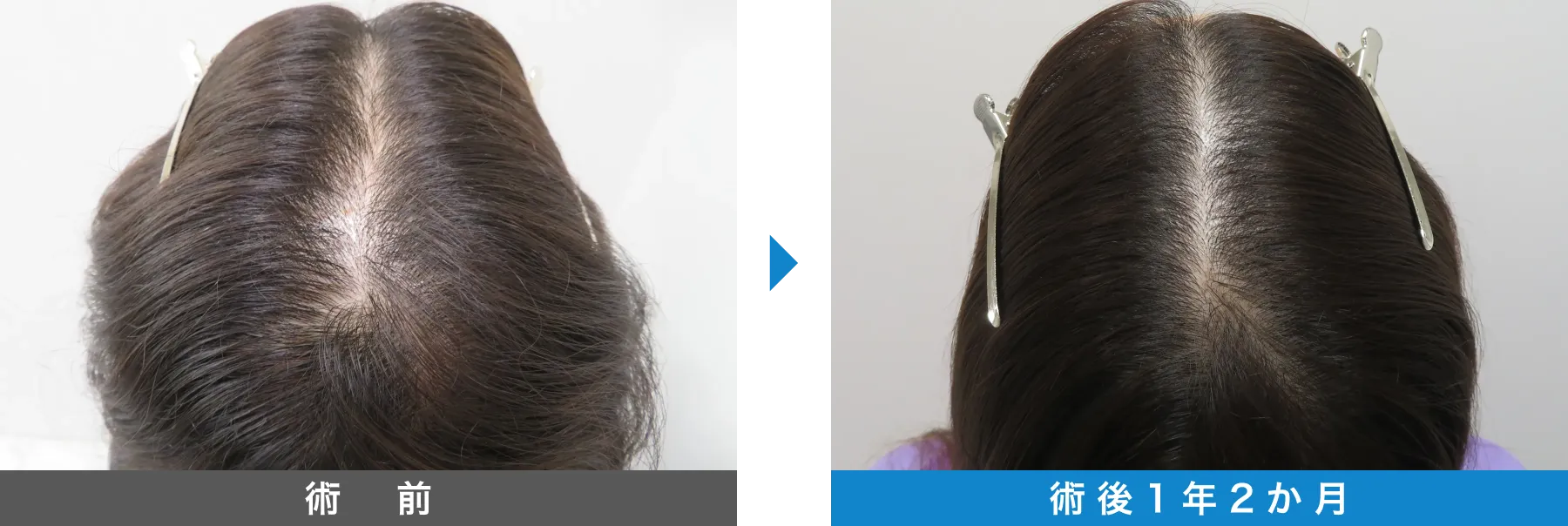 w-スカルプ 症例写真 術後 1年2か月