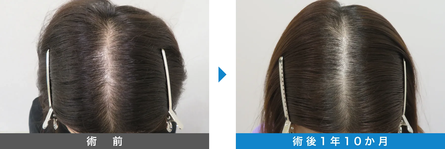 w-スカルプ 症例写真 術後 1年10か月