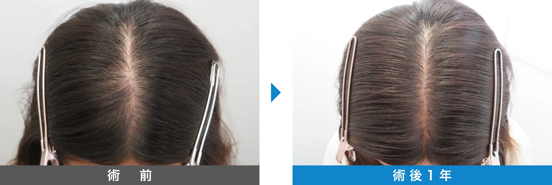 w-スカルプ 症例写真 術後 1年