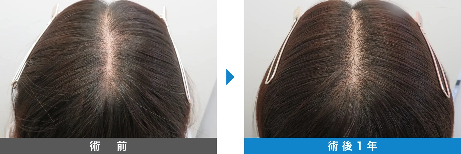 w-スカルプ 症例写真 術後 1年