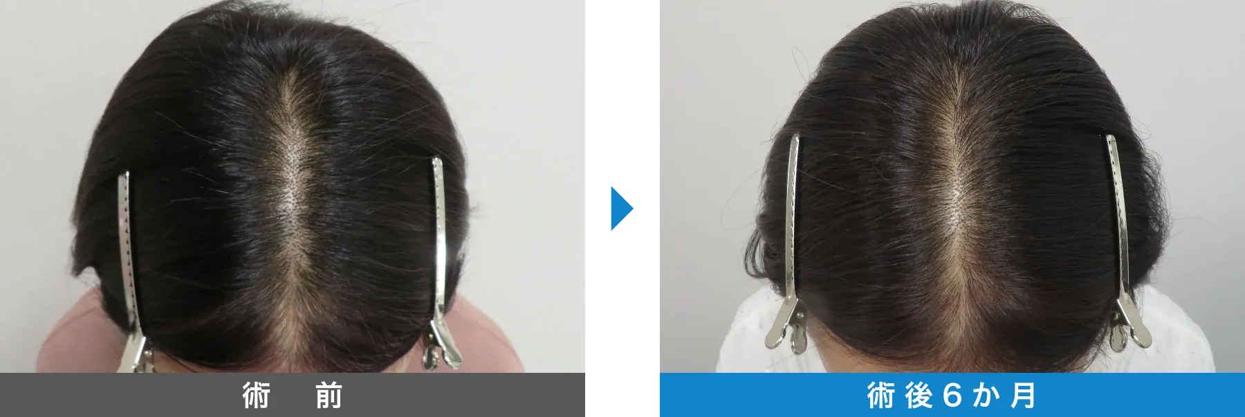 w-スカルプ 症例写真 術後 6か月
