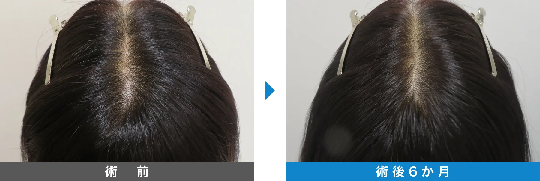 w-スカルプ 症例写真 術後 6か月
