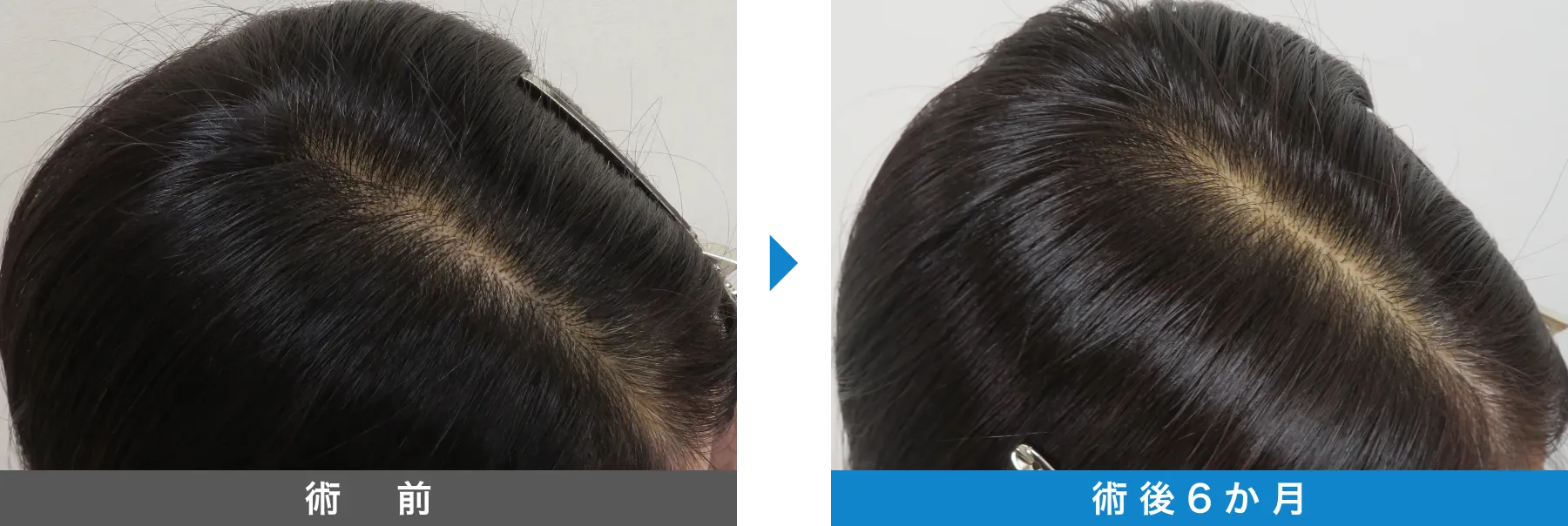 w-スカルプ 症例写真 術後 6か月