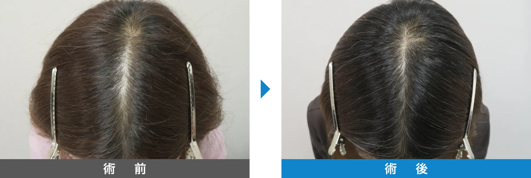 w-スカルプ 症例写真 術後