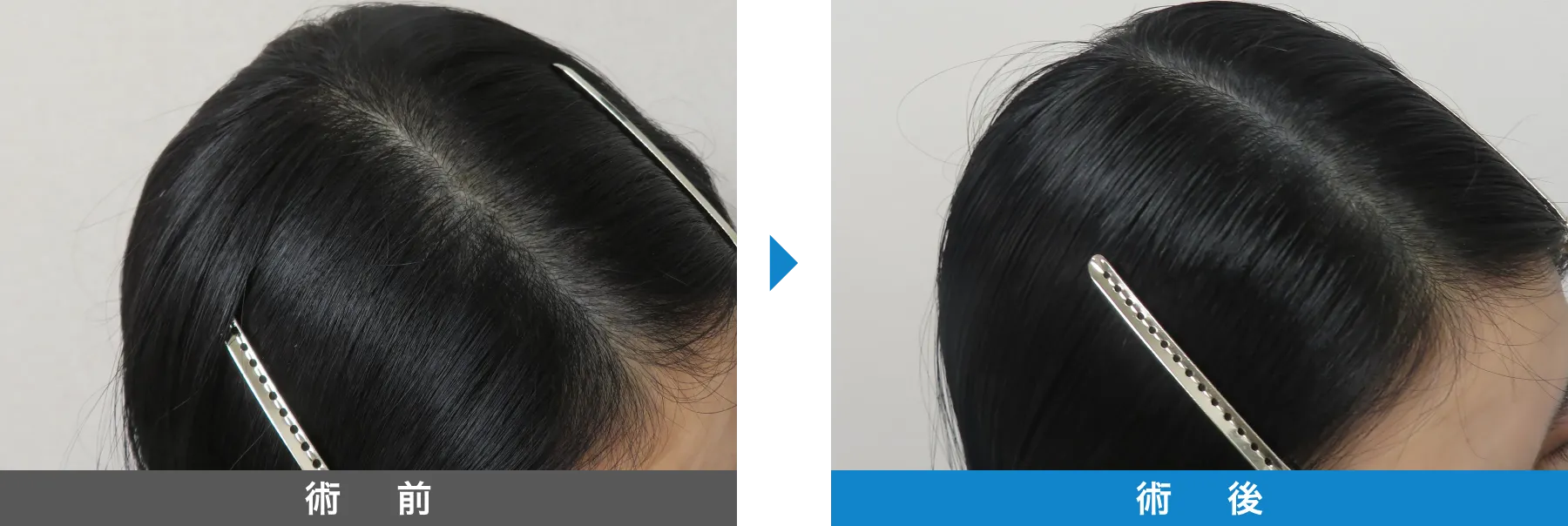 w-スカルプ 症例写真 術後