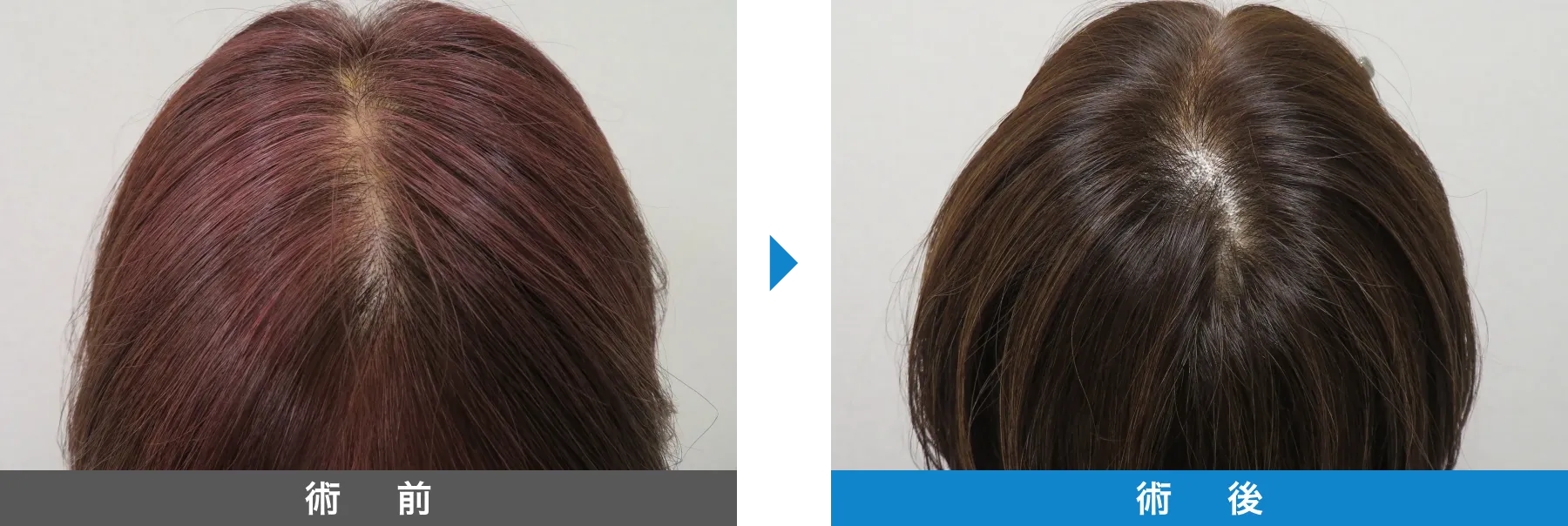 w-スカルプ 症例写真 術後