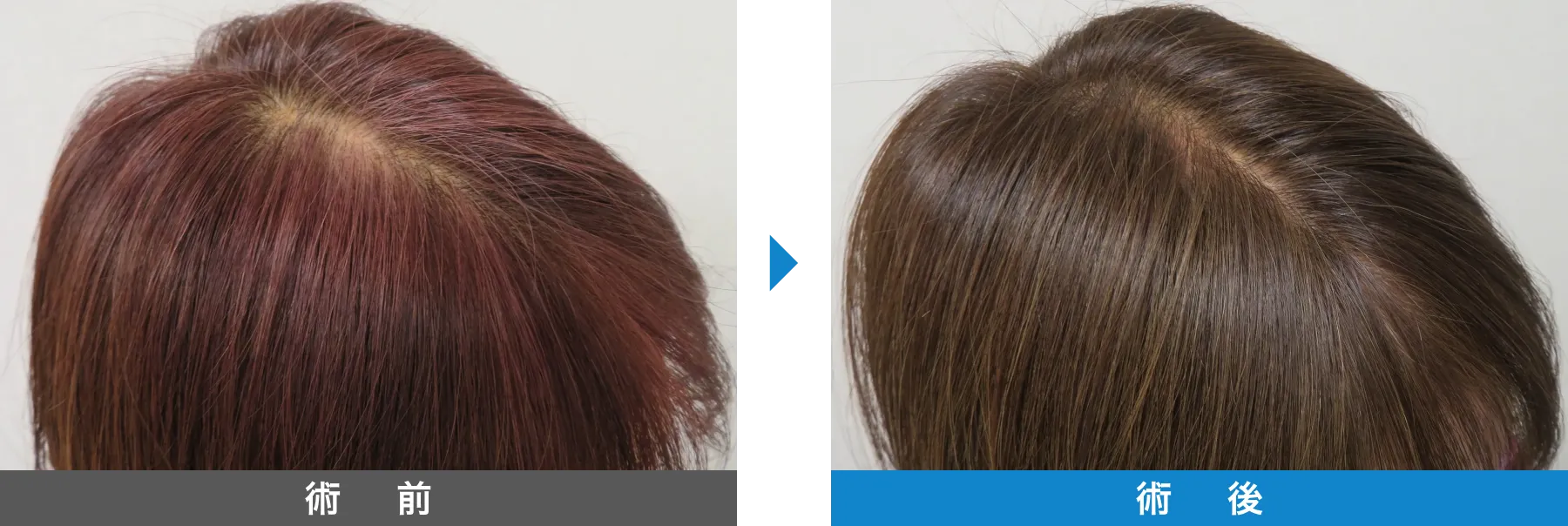 w-スカルプ 症例写真 術後