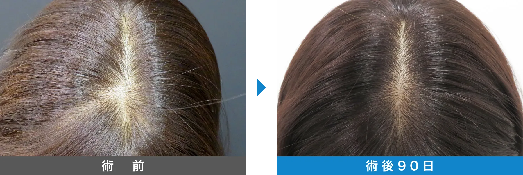 w-スカルプ 症例写真 術後 90日