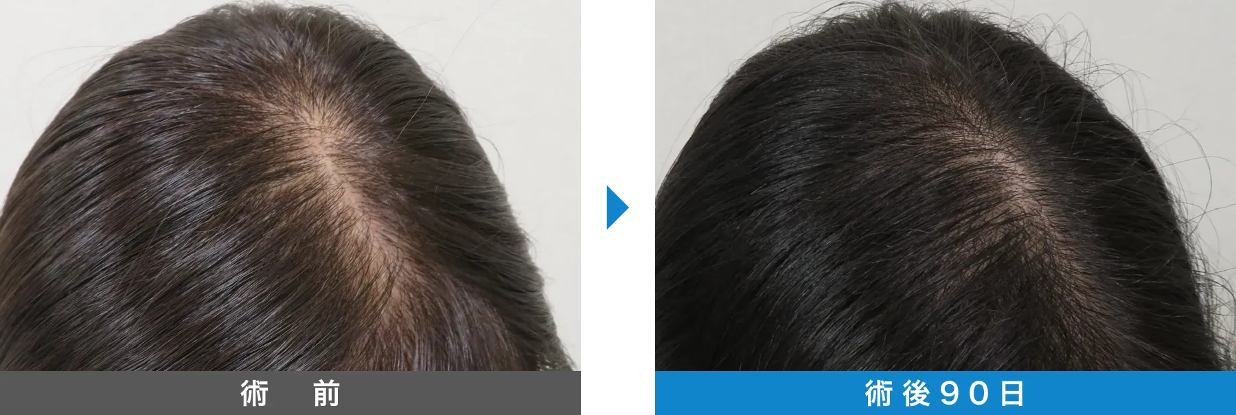w-スカルプ 症例写真 術後 90日