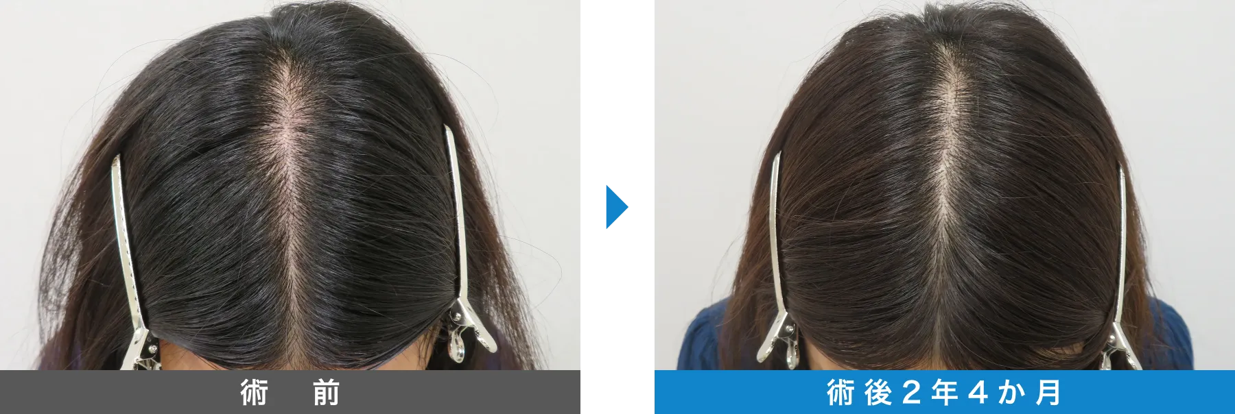 w-スカルプ 症例写真 術後 2年4か月