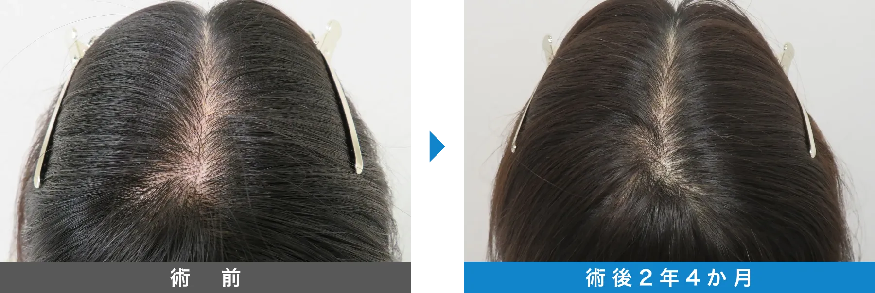 w-スカルプ 症例写真 術後 2年4か月