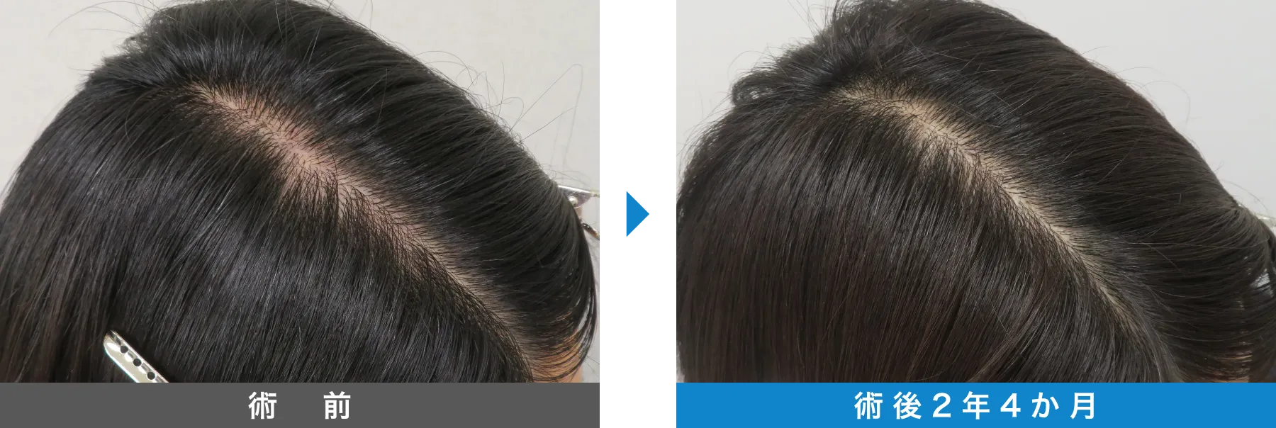 w-スカルプ 症例写真 術後 2年4か月