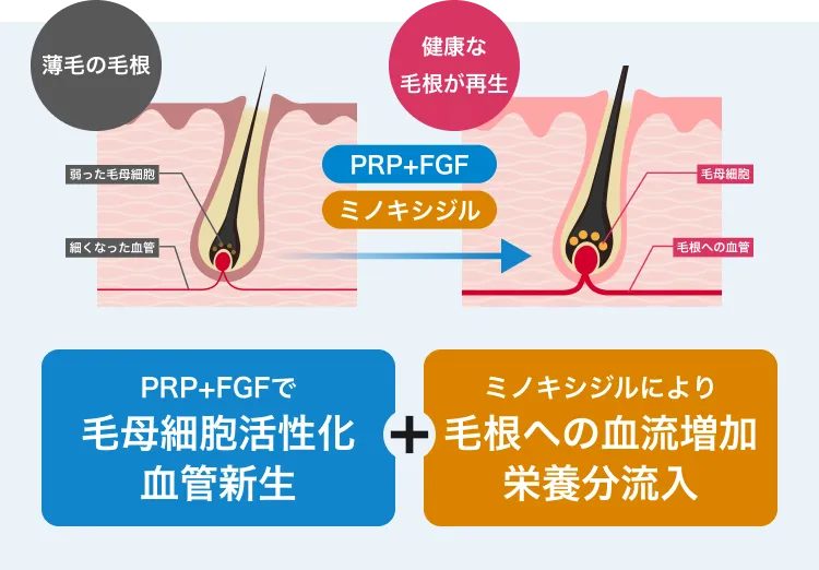 薄毛の毛根健康な毛根が再生