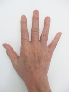 handvein-case17_after
