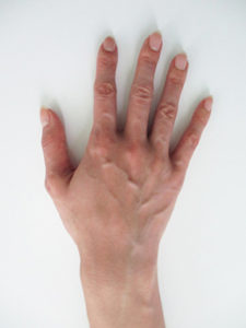 handvein-case19_before