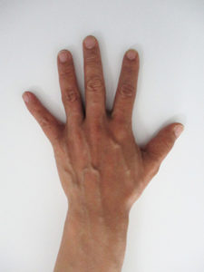 handvein-case20_before