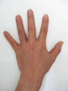 handvein-case20_after