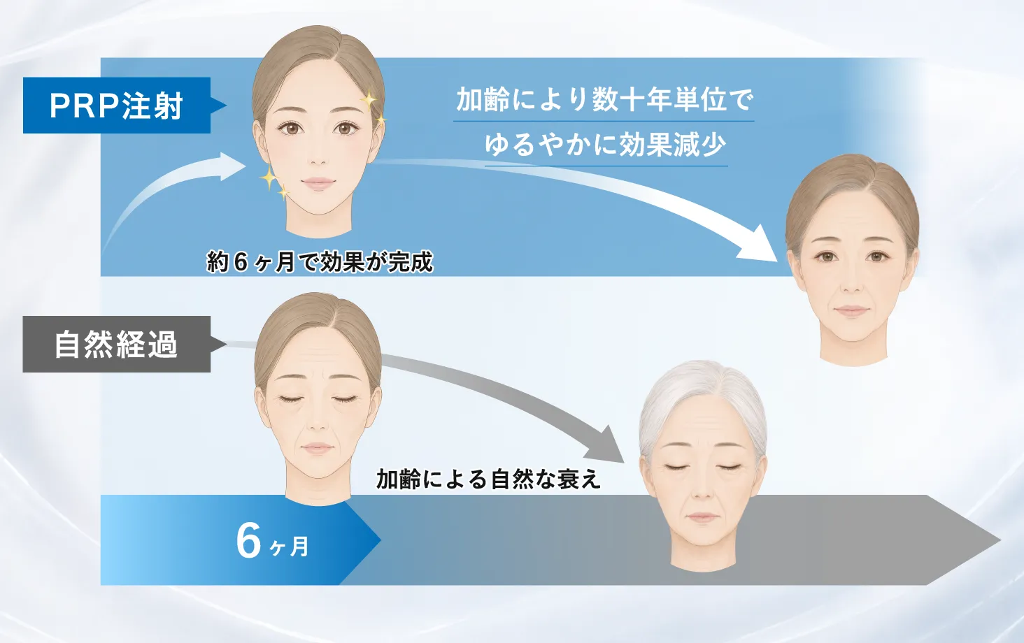 PRP注射の効果が約6ヶ月で完成し、その後は加齢とともにゆるやかに変化する経過を示す図解