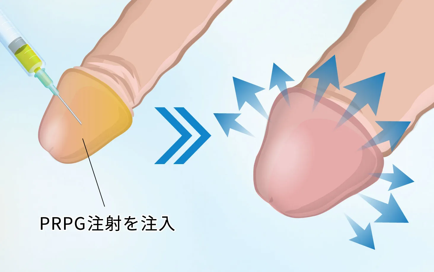 PRPG注射による亀頭増大術のイメージ図。亀頭に注入しボリュームアップを図るイラスト