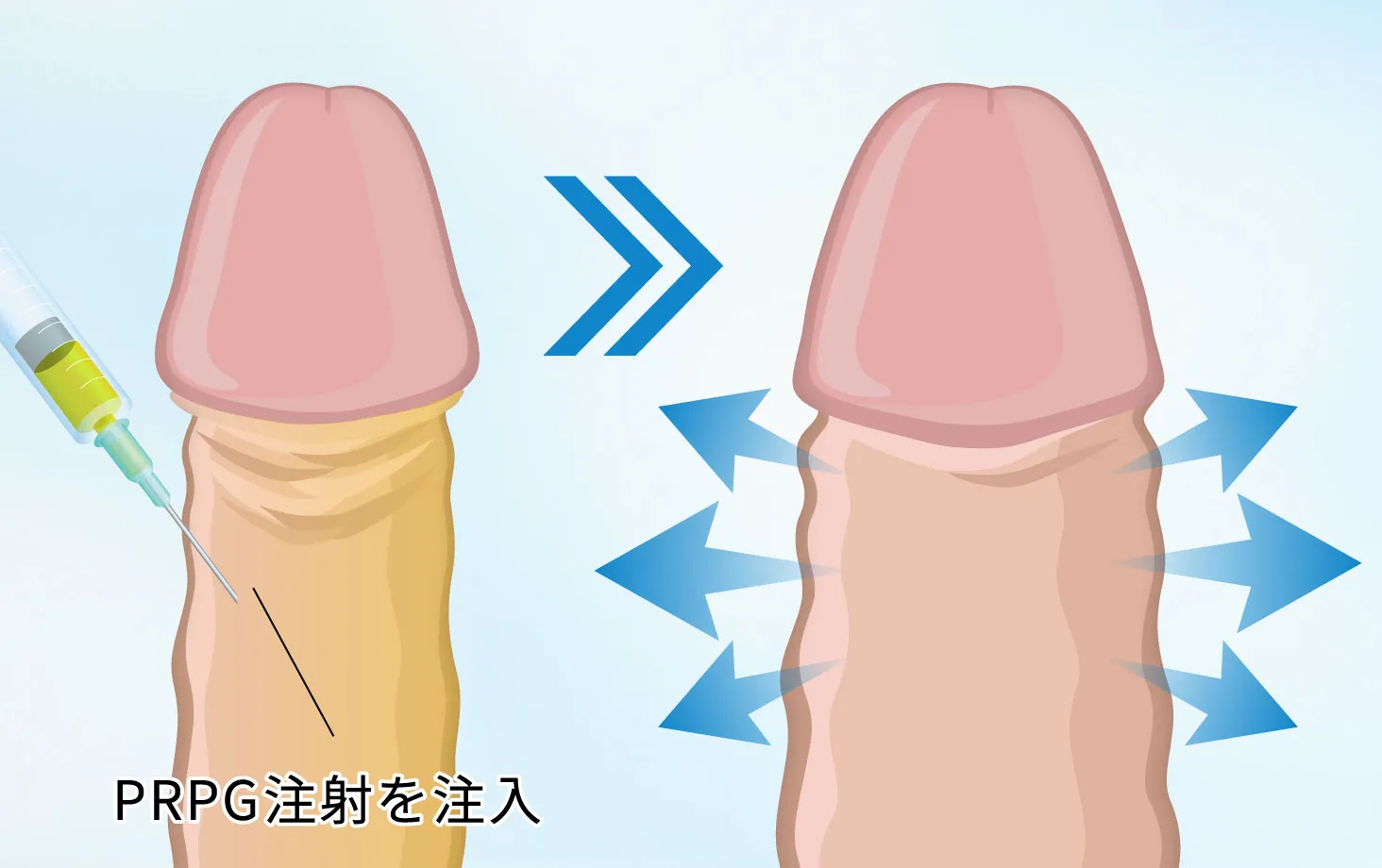 PRPG注射による陰茎増大術のイメージ図。陰茎に注入し太さを増強するイラスト
