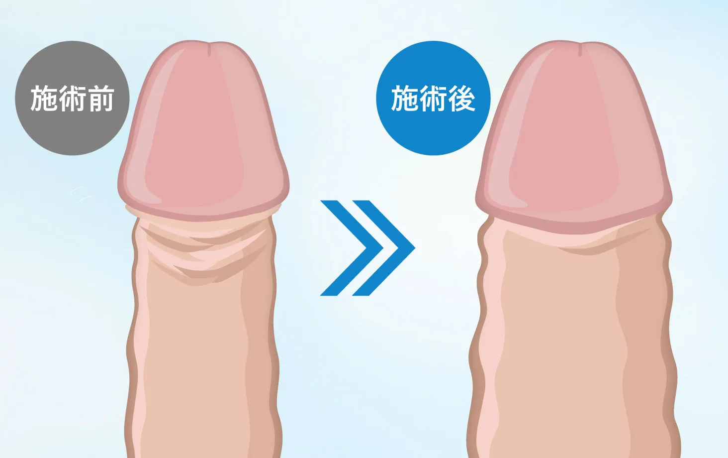 PRPG注射によるペニス増大の施術前・施術後のイメージ比較図