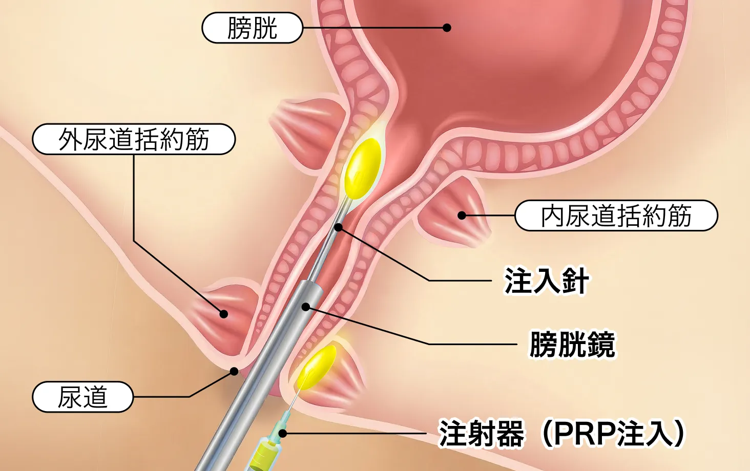 膀胱鏡と注入針で尿道周囲へPRPを注入する模式図