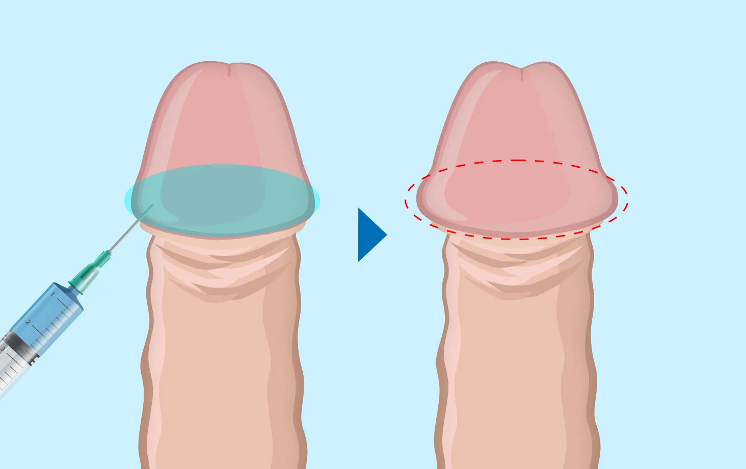 亀頭のカリへ注射し、カリが高くなった様子を示したイラスト