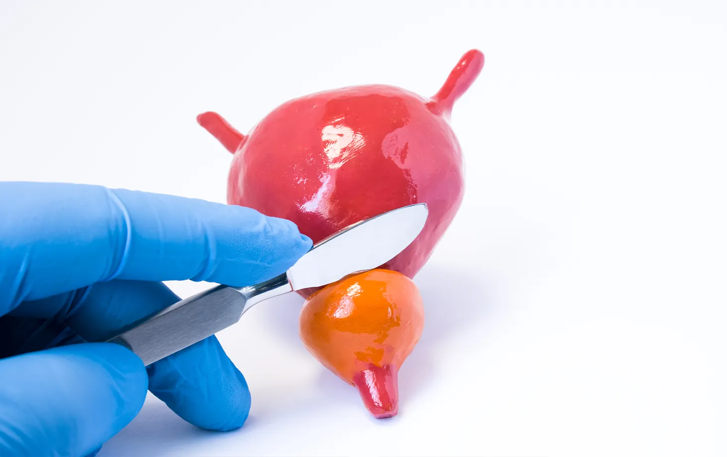 膀胱と前立腺の模型をメスで示し、前立腺摘出を説明するイメージ