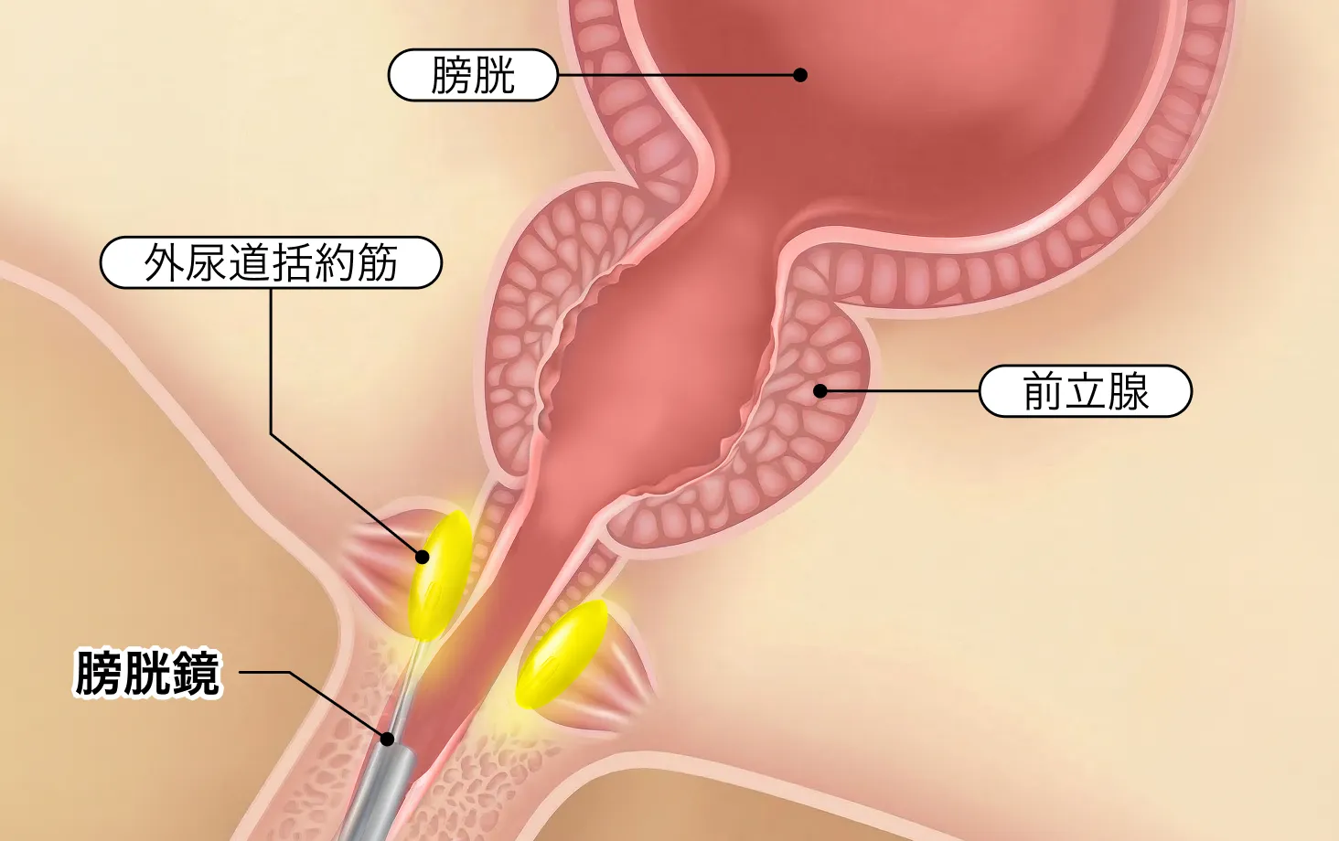 膀胱鏡を用いて外尿道括約筋へPRPを注入する模式図